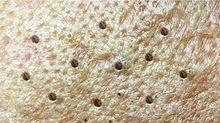 Relax Every Day With Loan Nguyen Spa | Acne Treatment Pimple Popping #41