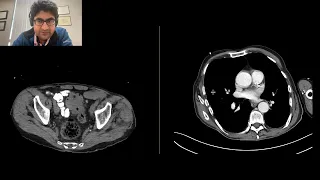 Large Bowel Obstruction