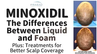 How Minoxidil Liquid and Foam Differ with Potential Scalp Irritation, and Other Hair Loss Treatments