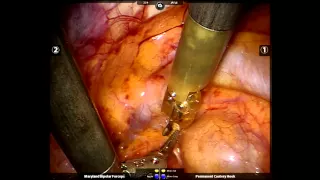 Robotic Mediastinal Parathyroid Adenoma Resection