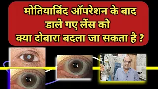 मोतियाबिंद ऑपरेशन के बाद डाले गए लेंस को क्या दोबारा बदला जा सकता है ? 👁️🧐 Lens Exchange..???