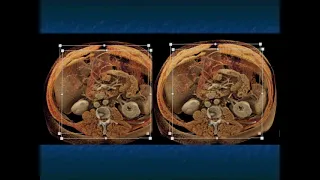 CT Evaluation of Small Bowel Tumors: Detection & Classification - Part 2