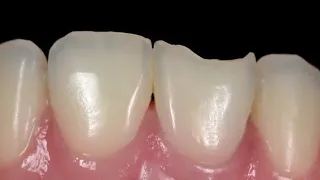 Class IV Composite Restoration || Clinical case