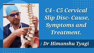 C4 - C5 Cervical Slip Disc- Cause, Symptoms and Treatment.