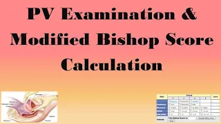 PV Examination & Modified Bishop Score Calculation