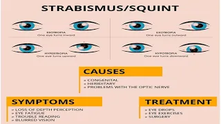 Squint || Strabismus || Complete understanding... part. 3