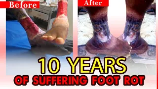 TEN YEARS OF FOOT ROT FOUND HEALING AFTER PRAYERS