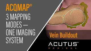 Acutus Mapping Modality — Vein Buildout Tool