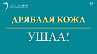 Убрали ДИАСТАЗ и ОБВИСШУЮ КОЖУ ЖИВОТА! Результат операции ДО и ПОСЛЕ #shorts