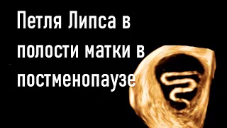 Петля Липса (ВМС) в полости матки в постменопаузе