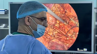 استئصال ورم الكلية الجزئي بمنظار البطن لابروسكوبي laparoscopic partial Nephrectomyدكتور حيدر العارضي