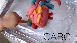 Playdough Surgery 🔪 ❤️ - Coronary Artery Bypass Grafting Surgery aka CABG 🥬