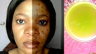 YOU WILL NEVER HAVE SPOTS AGAIN IF YOU WASH YOUR FACE WITH THIS MIXTURE BEFORE GOING TO BED