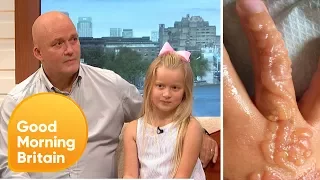 Black Henna Tattoo Scars Girl's Arm | Good Morning Britain