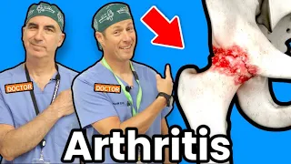 Treating Hip Arthritis Without Surgery