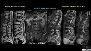 BENIGN/OSTEOPOROTIC COMPRESSION VS MALIGNANT/PATHOLOGICAL FRACTURES -BASIC AND ADVANCED IMAGING.