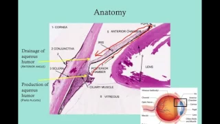 Glaucoma   CRASH! USMLE Step 2 and 3