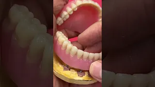 Denture from mini implants!