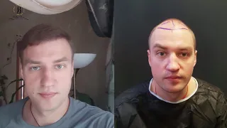 Результат пересадки волос со всех ракурсов через 8 месяцев - видео отзыв Олега