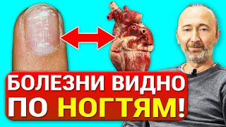 Как определить болезни по ногтям? 12 Знаков на ногтях, указывающих на проблемы со Здоровьем!