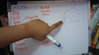 MYOPIA important concept made easy part 1