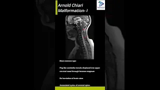 Arnold Chiari Malformation- I