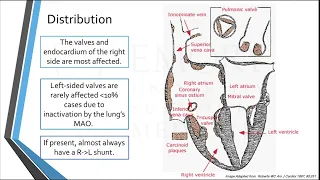 Carcinoid Heart Disease: The known and yet to be known.