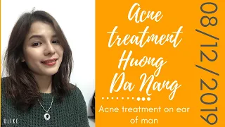 Acne treatment on ear of man 08/12/2019