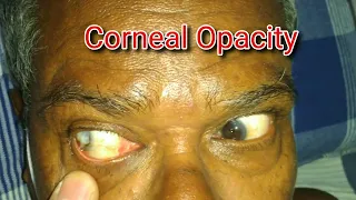 Complete Corneal Opacity 😳 😳