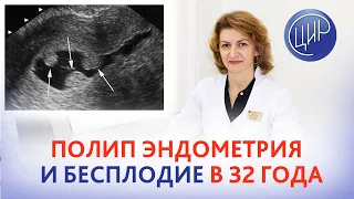 Полип эндометрия и бесплодие в 32 года. Дементьева С.Н.