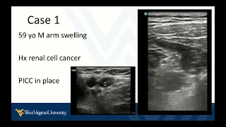 DVT POCUS 5 - Upper Extremity DVT and Summary