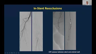 BeBack for Crossing Occluded Stent