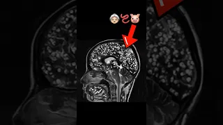 Tapeworm INFESTED Grandma’s Brain, Here’s What Happened Next… #medical #parasite