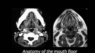 Imaging of Tongue and mouth floor  Prof Dr  Mamdouh Mahfouz In Arabic 720p