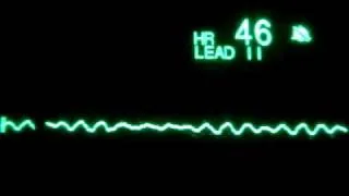 Fine Ventricular Fibrillation