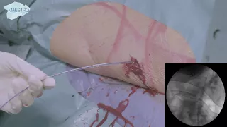 Supine - PCNL for a renal stone in the left renal pelvis using dual action lithotripsy