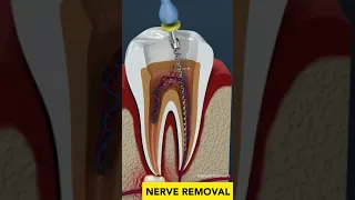 Tooth Cavity & Root Canal