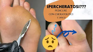 👣PEDICURE / 🆘✅ IPERCHERATOSI / Cos'e? e come rimuoverla/