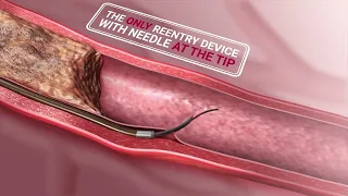 BeBack - The only crossing and re-entry catheter