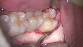 Easy third molar extraction with piezo