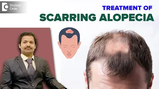 SCARRING ALOPECIA Treatment | Patchy Hair Loss & Hair Regrowth-Dr.Deepak P Devakar |Doctors' Circle