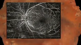 OCT Angiography in Proliferative Diabetic Retinopathy