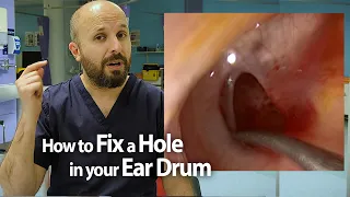 How to fix a Hole in your Ear Drum (tympanoplasty)