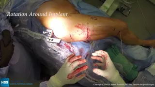 Precice Femur Lengthening: Live Surgery by Dr. Rob Rozbruch