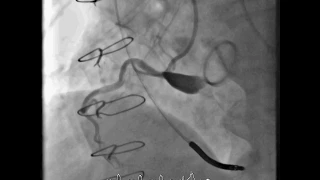 Iatrogenic ascending aortic dissection