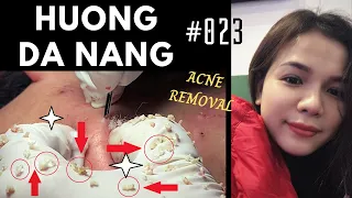 #023 | ACNE REMOVAL and acne treatment | Lấy và điều trị mụn | Hương Đà Nẵng | akne Behandlung