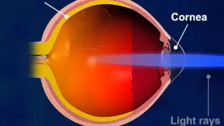 Lasik Surgery Procedure - Asian Eye Hospital Pune | Dr Vardhaman Kankariya | Best Awarded Surgeon