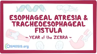 Esophageal atresia & tracheoesophageal fistula (Year of the Zebra)