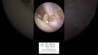 Ear Wax Removal - full episodes on all our socials! Feel free to follow for more! #earwaxremoval