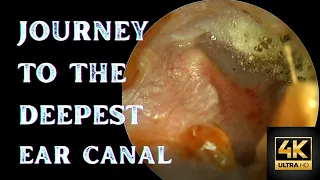 Otomycosis - A Journey to The End of Ear Canal